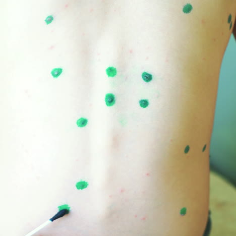 baby with chicken pox. close-up square video