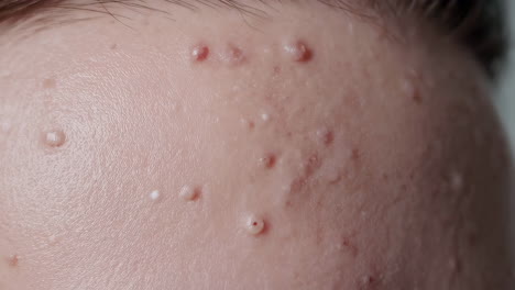 close-up of a forehead with skin lesions