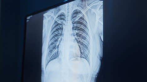 chest xray result displayed on screen. closeup