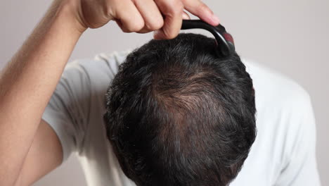 Tratamiento-De-Pérdida-De-Cabello-Con-Microagujas-Para-El-Cuero-Cabelludo-Calvo-Para-Volver-A-Crecer-El-Cabello-Usando-Dermaroller,-Terapia-De-Inducción-De-Colágeno