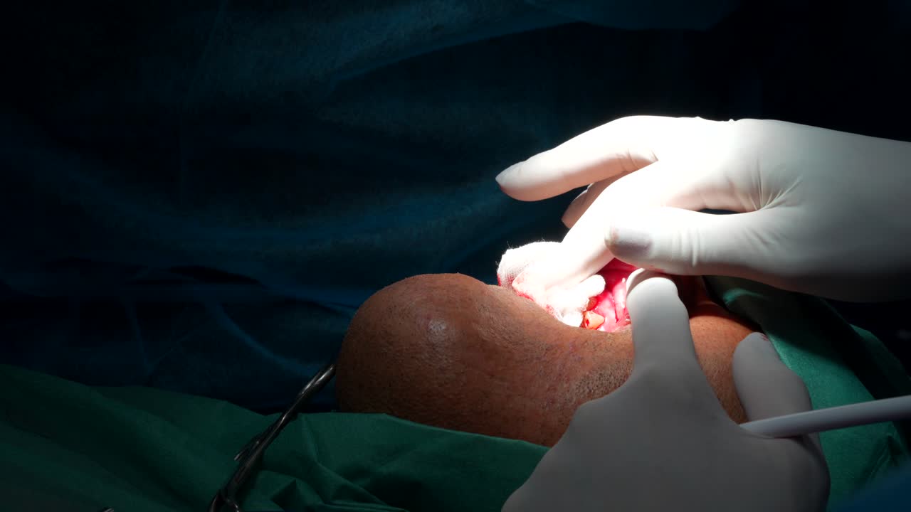 Odontologist cutting stitching thread and his assistant stops bleeding during dental surgery. Close up