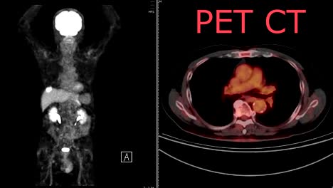 positron emission tomography (pet) of