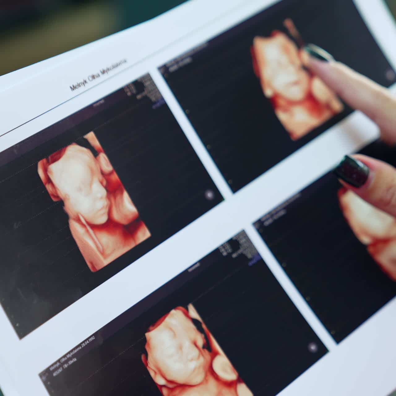 Una mano femminile tocca le immagini di un bambino sulle scansioni ecografiche. La mamma ha ricevuto i risultati dell'esame ecografico di gravidanza. Primo piano
