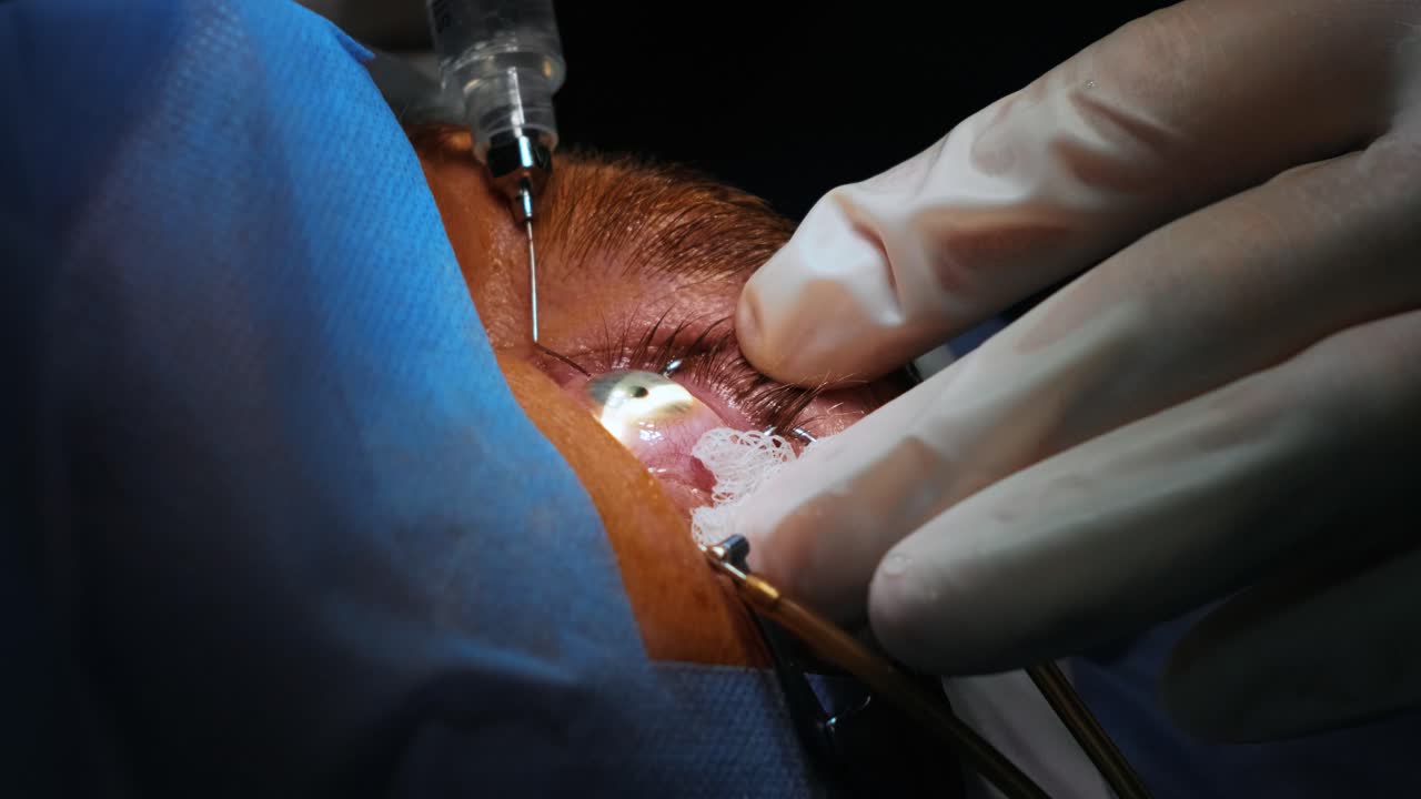 레이저 시력 교정: 안과 수술 중에 수술실에 있는 환자와 수술팀; 눈꺼풀 스럼; 라식 치료; 불임 개 아래의 환자