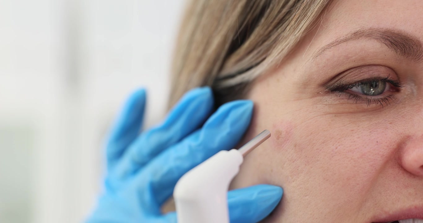 Il dermatologo usa la tecnologia laser per rimuovere una cicatrice da acne