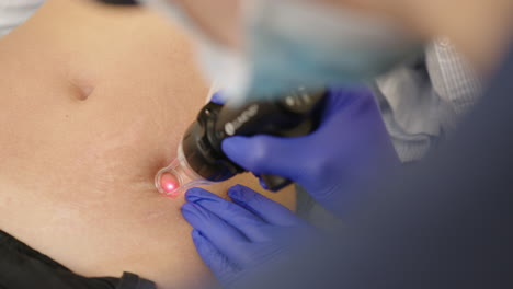 tratamiento con láser en el abdomen