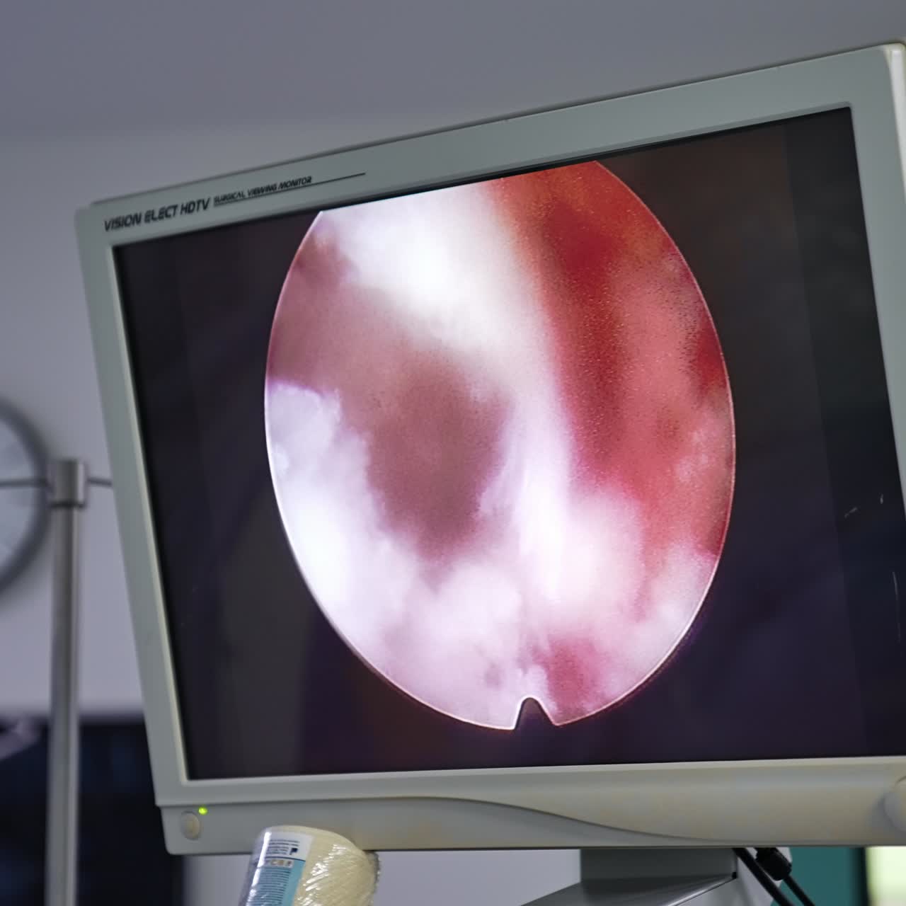 Screen showing the micro shot of operated area. Advanced equipment necessary at modern operation room for neurosurgeries