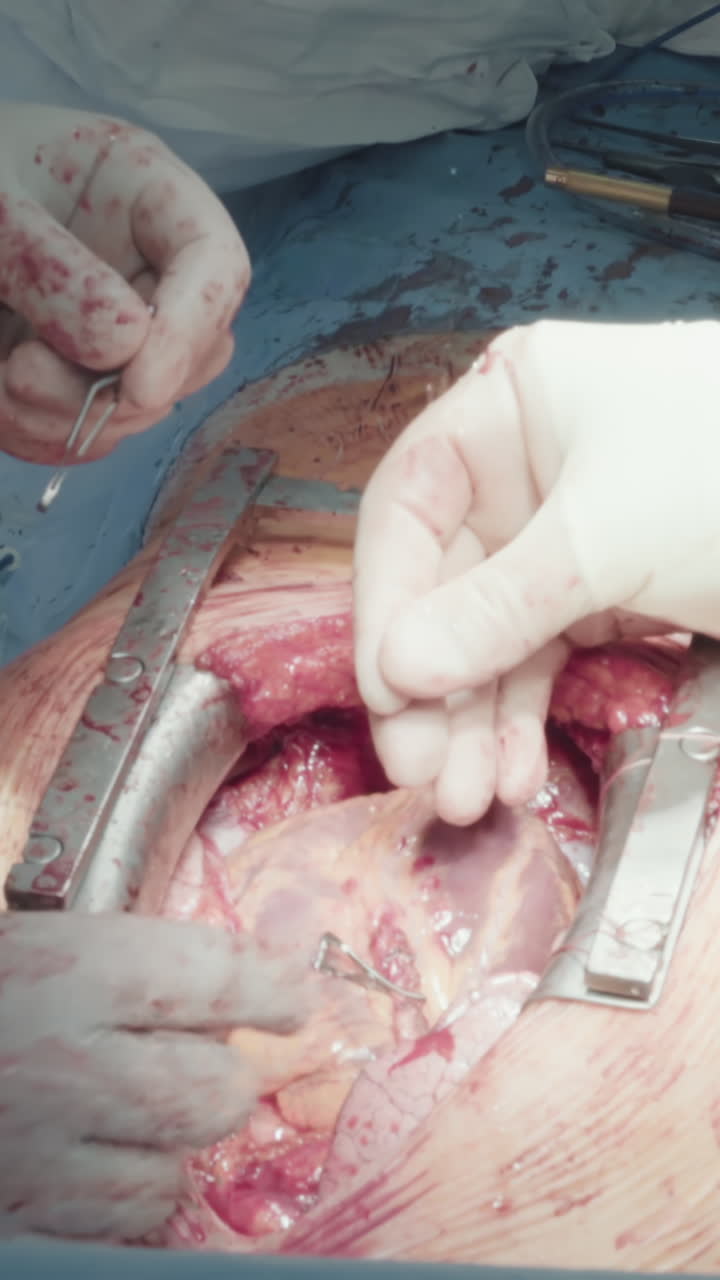 asistente vierte solución sobre el corazón. cirujanos cardiotorácicos hábiles operan al paciente que realiza una cirugía de derivación de la arteria coronaria en la sala de operaciones