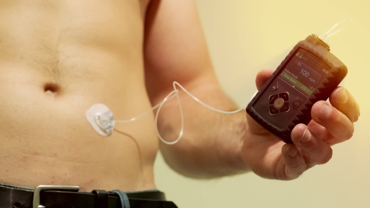 Diabetic man with an insulin pump connected in his abdomen and holding the insulin pump at his hands. Diabetes concept.