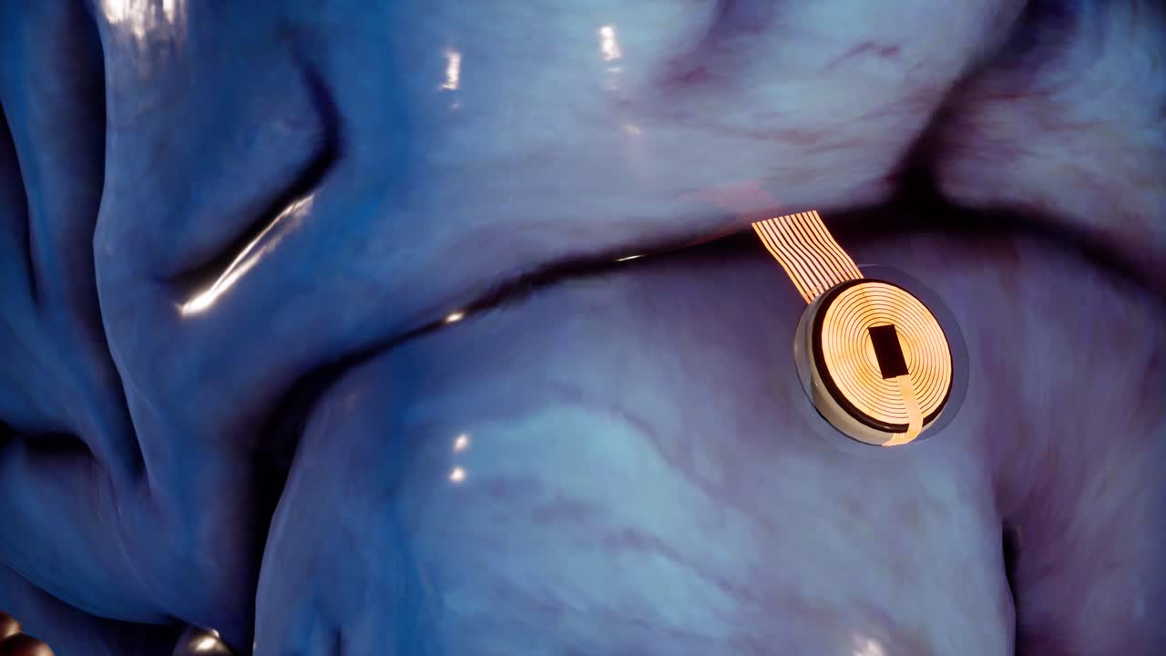 애니메이션 신경 인터페이스 임플란트 기술