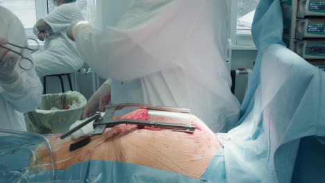 surgeon uses sutures to close chest. doctor uses absorbable sutures to close facial layer ensuring proper closure following coronary artery bypass procedure