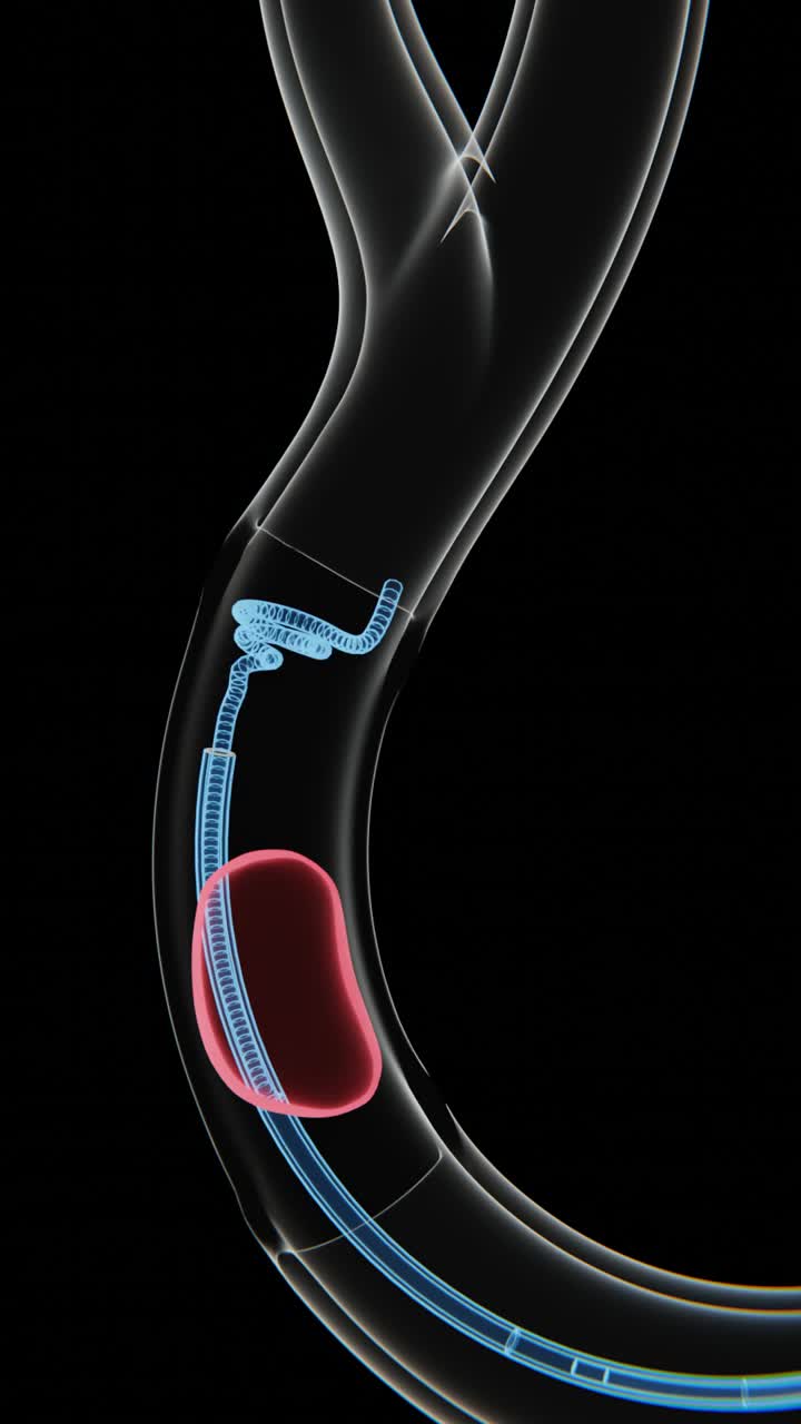 Vertical video of Mechanical Thrombectomy (Clot removing) process in 4K | Mechanical Thrombectomy visualization video in HD