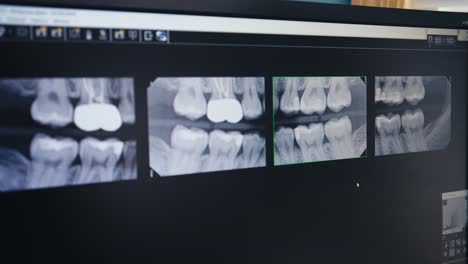 teeth dental x rays on a computer screen in a dental office