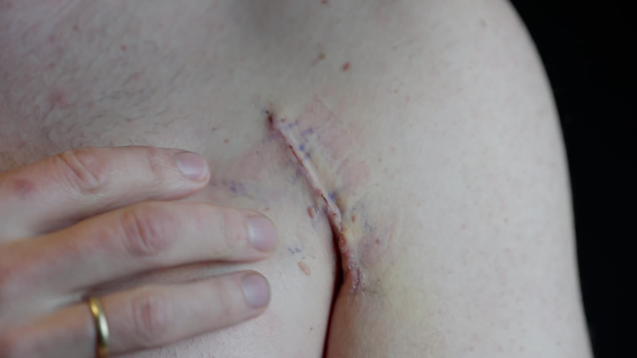 Man gently stretches and touches fresh scar on chest after pectoralis tendon surgery. Blue surgical markings still visible