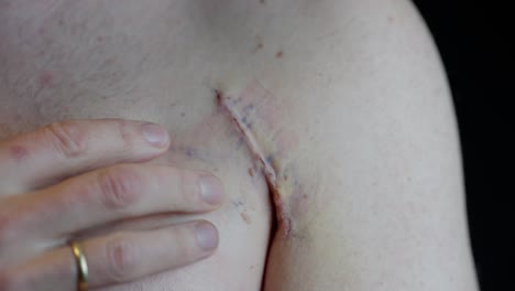 man gently stretches and touches fresh scar on chest after pectoralis tendon surgery. blue surgical markings still visible