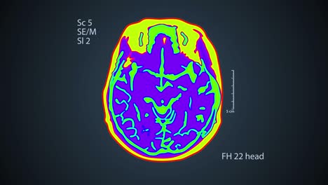 escáner cerebral. una vista en la pantalla. 4k médico de fondo colorido