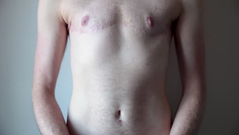 transgender man showing surgery scars on chest