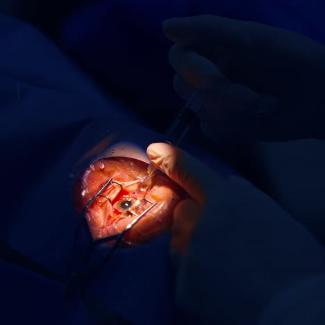 close up detail of surgery of eye
