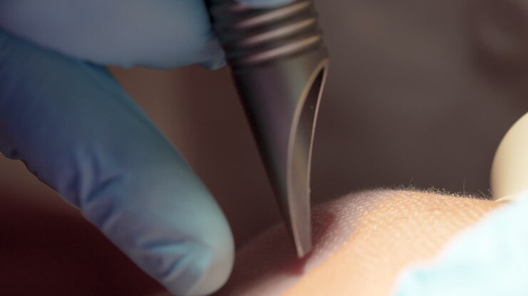close-up of a laser treatment procedure on skin, where a handheld laser device, guided by a professional in blue gloves, is being applied to the patient's skin, likely for medical or cosmetic purposes