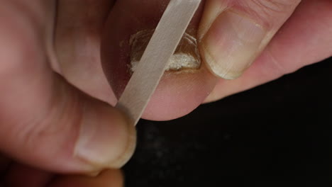 close-up of a thick fungal toenail being filed on a black clinical background