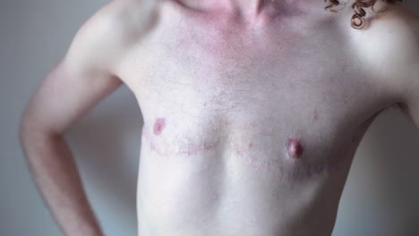 transgender man showing surgery scars on chest