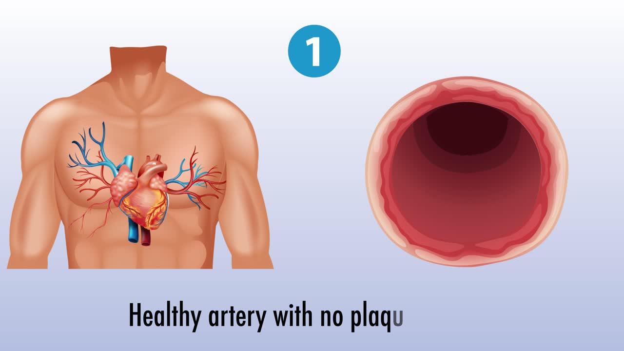 ilustración de las etapas de la aterosclerosis en las arterias