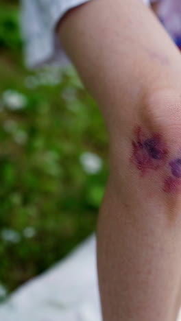 injured knee with bruises