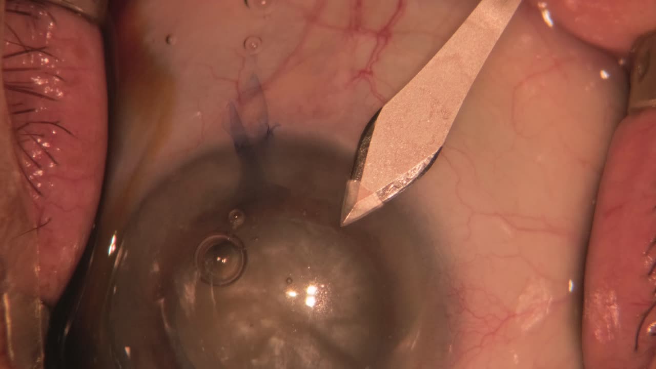 el bisturí corta el ojo. imágenes macro de los ojos durante la cirugía ocular. cirugía oftalmológica.