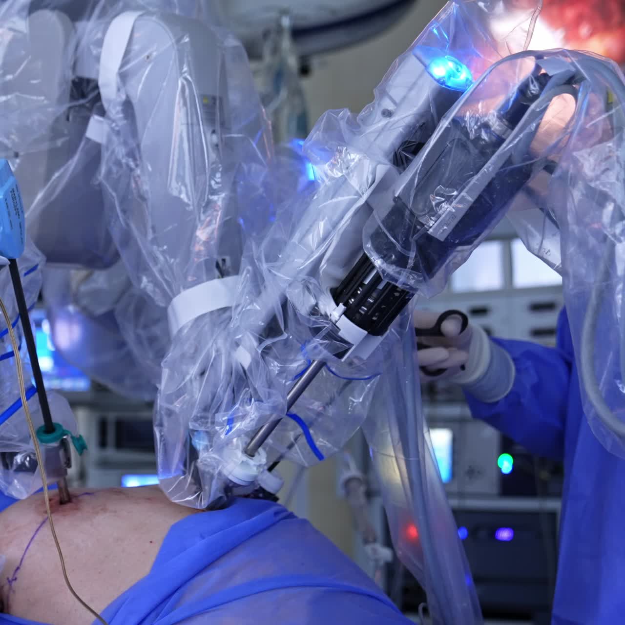 Abdominal laparoscopic surgery performed by robot surgeon. Unrecognized doctor in latex gloves holding the instrument. Screen with procedure at backdrop