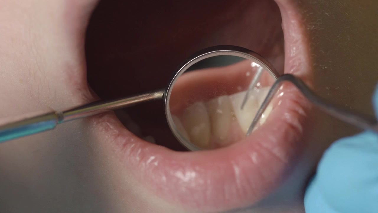 Dentista examinando los dientes del paciente con espejo dental y sonda