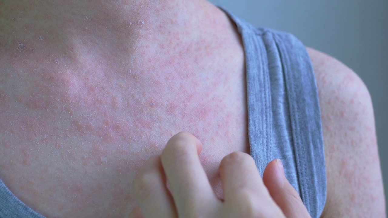 다른 크기의 둥근 반점의 형태로 은 발진의 클로즈업  - 그들은 손가락으로 반점을 만니다 - 신체는 회색 옷을 입고 있습니다 - 바이러스 질병 - 피부 가려움증