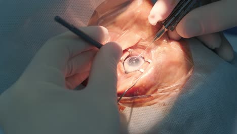 cataract surgery close up. surgeon operating eye cataract in hospital surgery