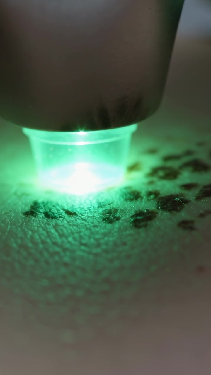 Video verticale: Attivazione di un dispositivo a coppa con LED verde che scansiona punti della pelle in clinica, diagnosticando il pigmento.