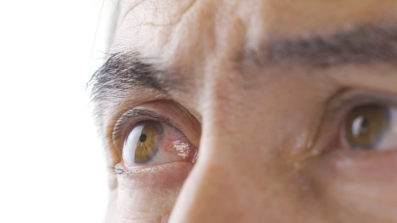 눈 질환 (프테리기움)