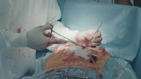 surgeon in uniform closes incision. focused doctor uses micro forceps and needle holders connecting parts of cavity with sutures in operating room