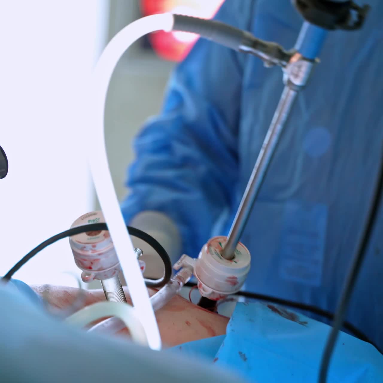 Medical equipment on a patient during surgery. Doctors perform an operation using modern surgical instruments in the operating room. Close-up.
