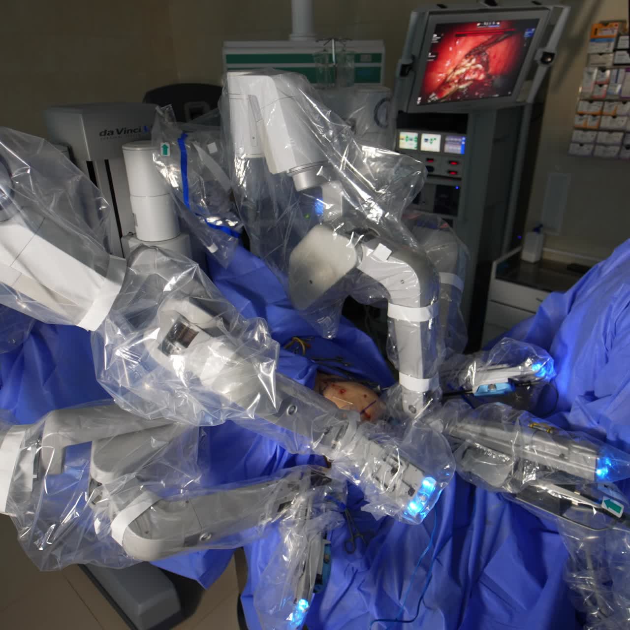Male doctor stand close by the working Da Vinci surgeon. Human professional watches the work of robotic surgeon on the screen