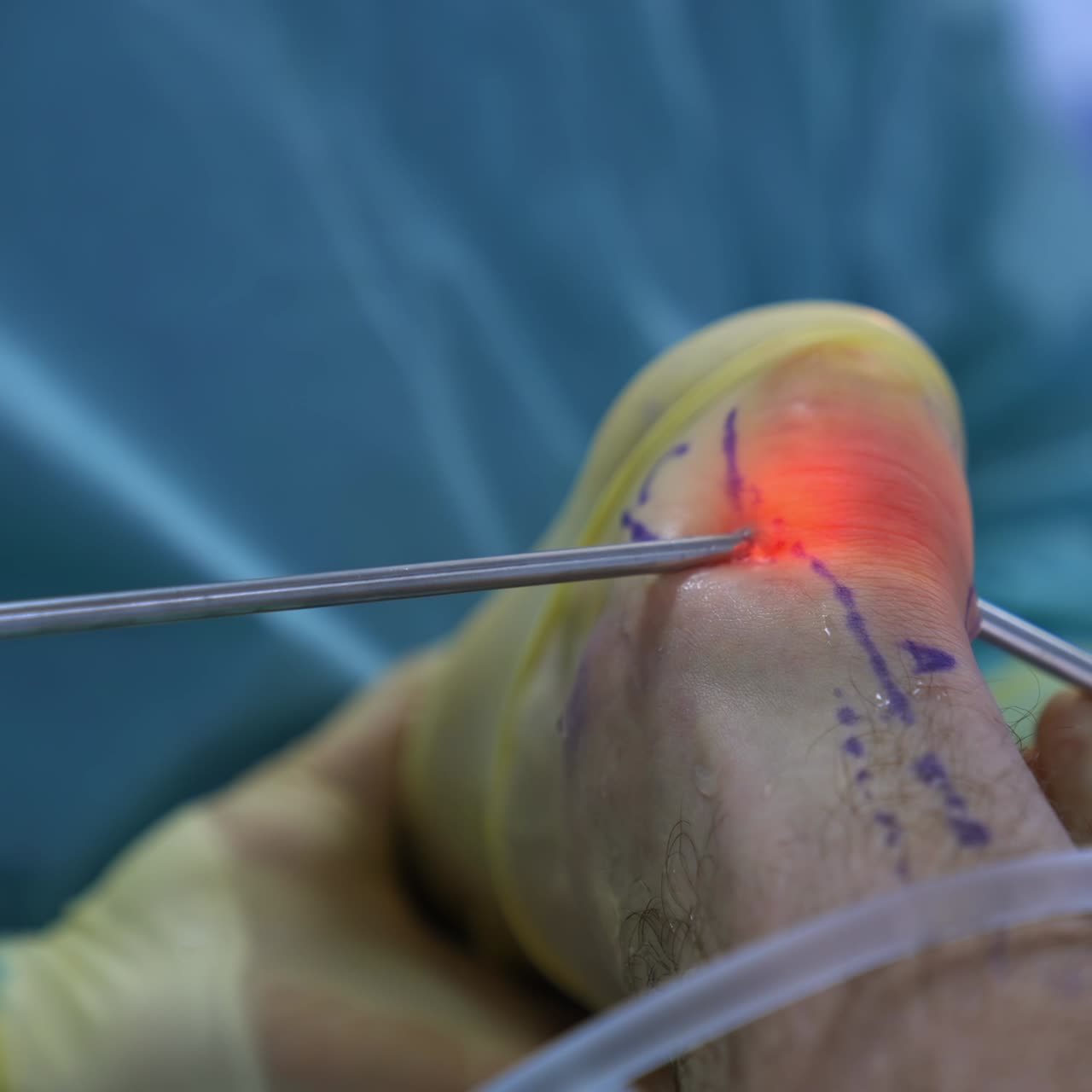 Process of trauma surgery operation. Close up of hands of the professional surgeon during operation