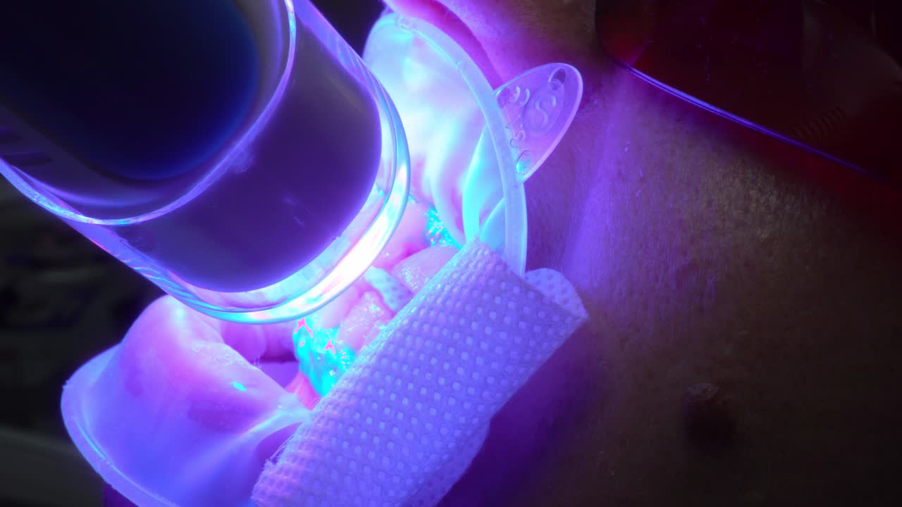 UV Whitening Teeth - An ultra violet whitening machine closeup in operation on a patient's teeth. Shot in 4k