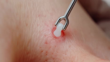 extracting a pimple