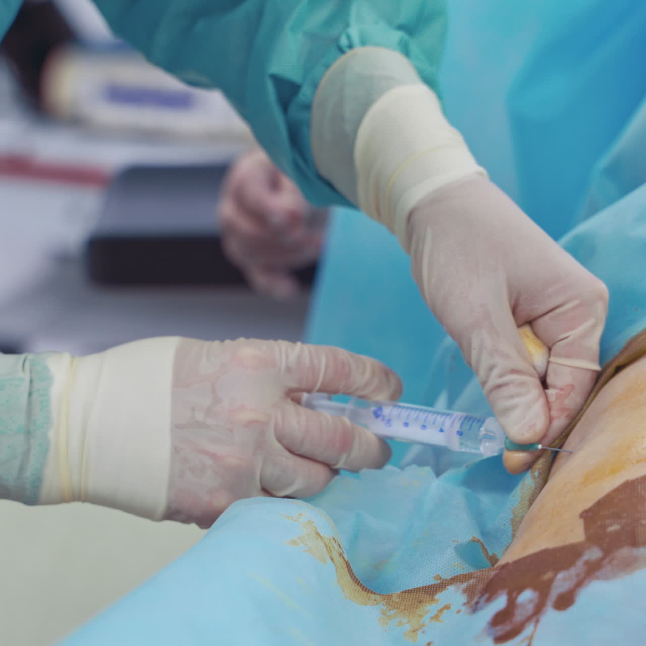 Stem cell injection procedure. Male's hands in gloves with syringe. Doctor makes an injection to the patient. Close-up.