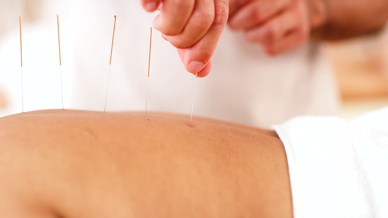 sesión de tratamiento con acupuntura