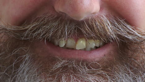 closeup of bad teeth and crooked incisors in need