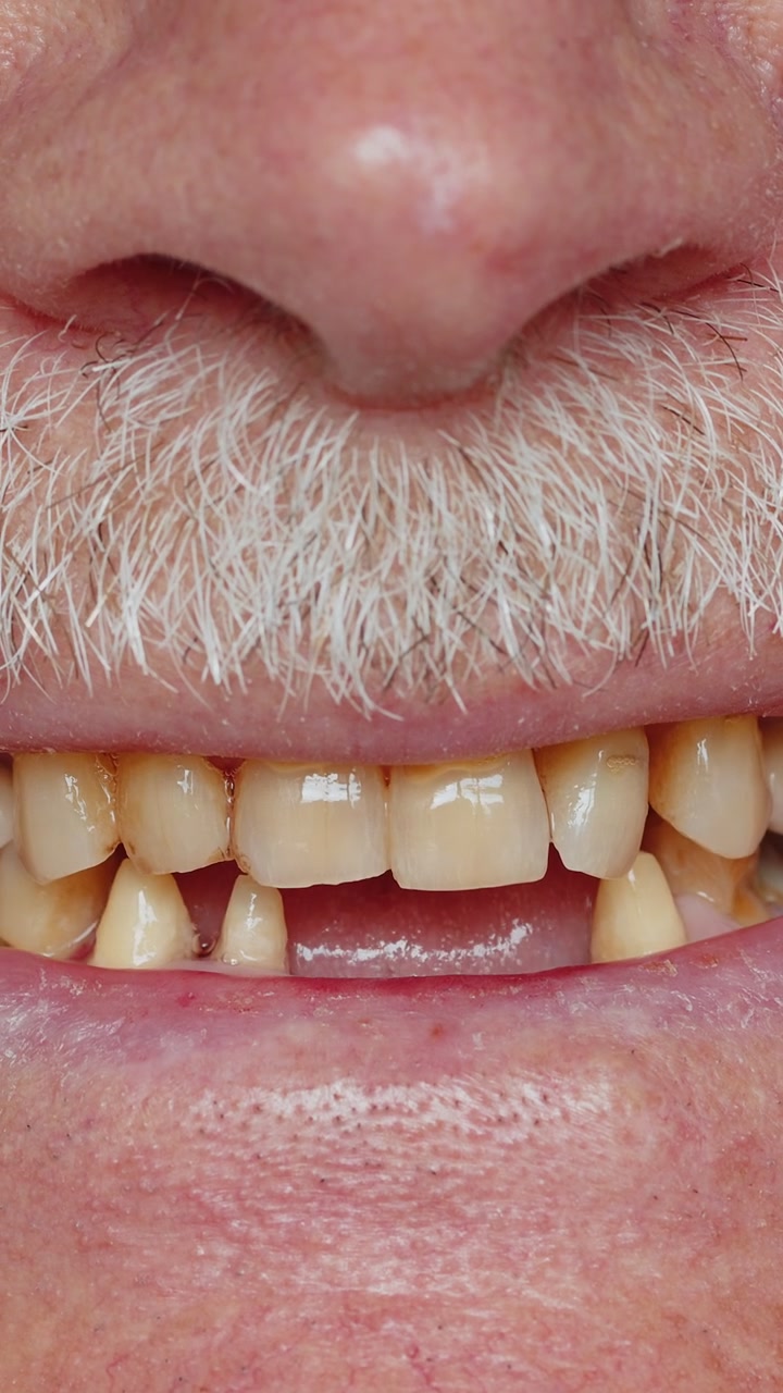 Sorriso maschile senza denti bocca di anziano anziano uomo problema dentale cattivo denti marci perdita carie