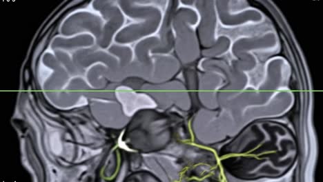 brain mri scans
