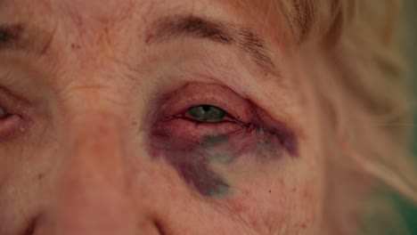 close up on elderly female black eye trauma damage injury looking at camera