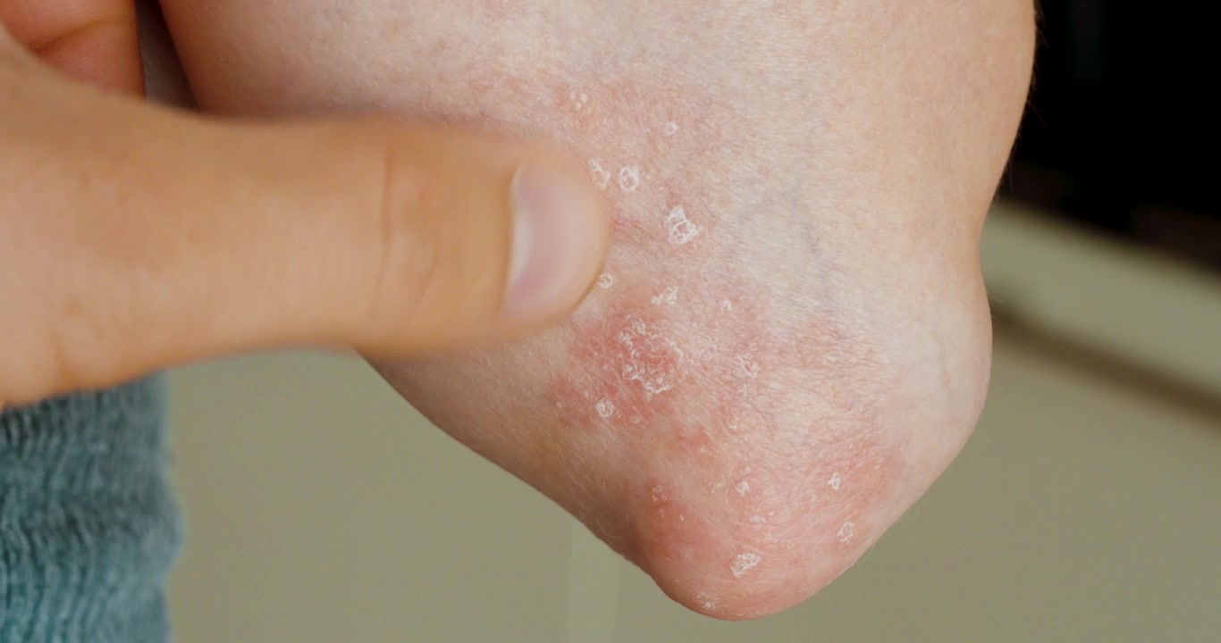 Close-up of dry, red and flaky skin on an elbow, representing psoriasis, skin irritation, scaling, itching, and dermatological problems.