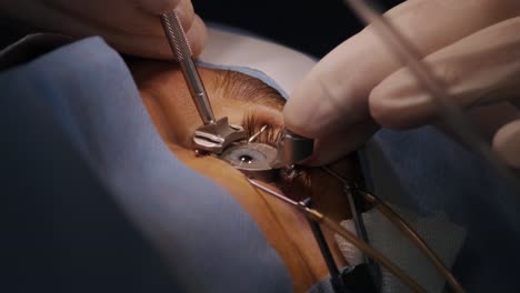 laser vision correction. a patient and team of surgeons in the operating room during ophthalmic surgery. eyelid speculum. lasik treatment. patient under sterile cover