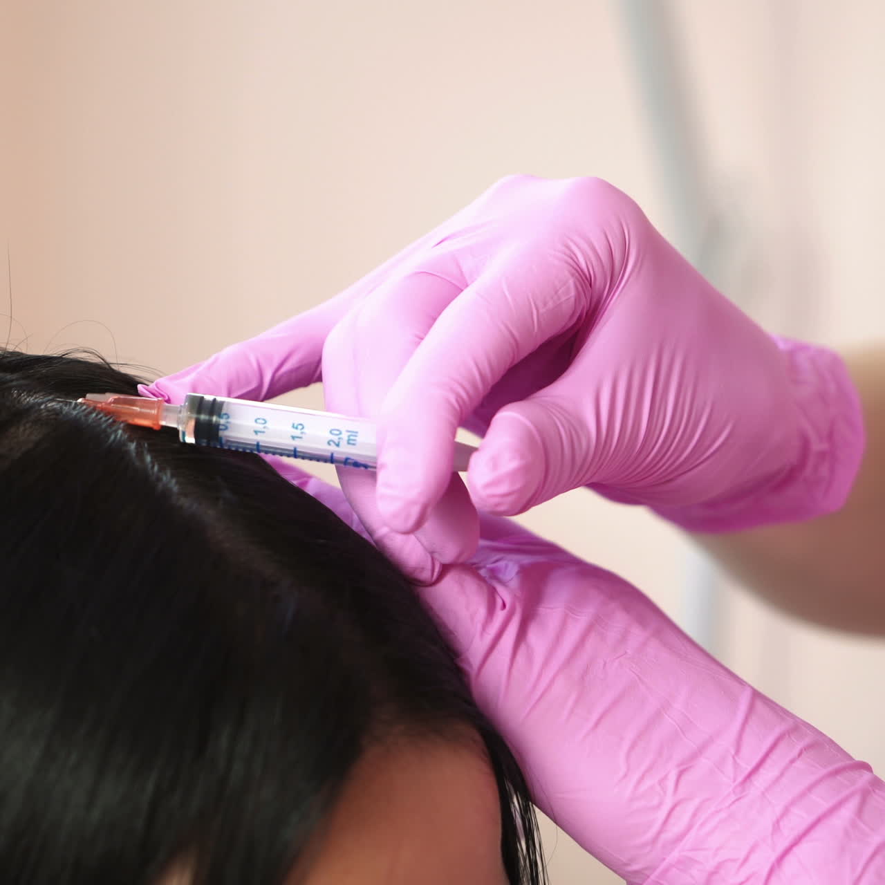 Patient getting head injections. Concept of hair loss. Cosmetological clinic