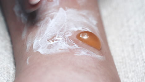 patient applies medical ointment to painful infected blisters to treat pain and redness